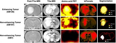 MRI and amino acid PET detection of whole-brain tumor burden